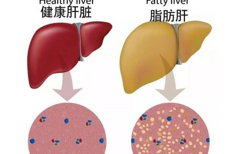 脂肪肝防治小贴士：脂肪肝症状有哪些，哪些食物不宜多吃？