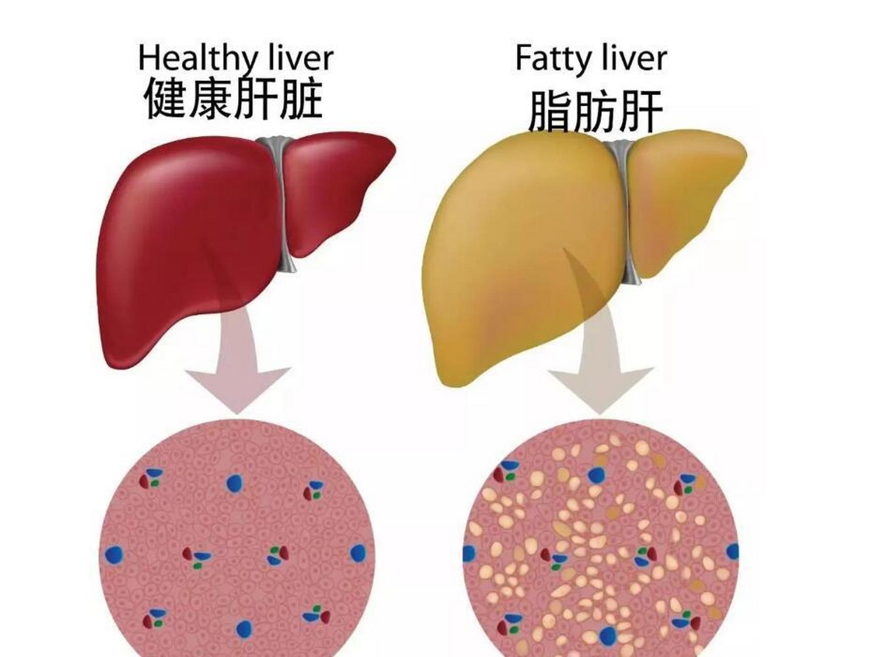 脂肪肝防治小贴士：脂肪肝症状有哪些，哪些食物不宜多吃？