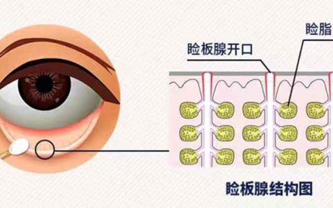 眼皮边缘长小泡，或是MGD添烦恼