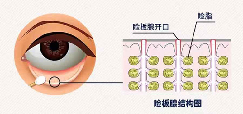 眼皮边缘长小泡，或是MGD添烦恼