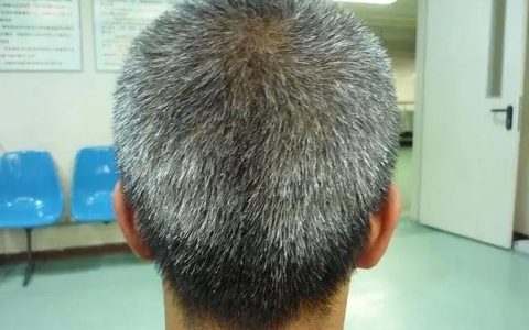 揭秘“少白头”：为何青春未老，发已白？