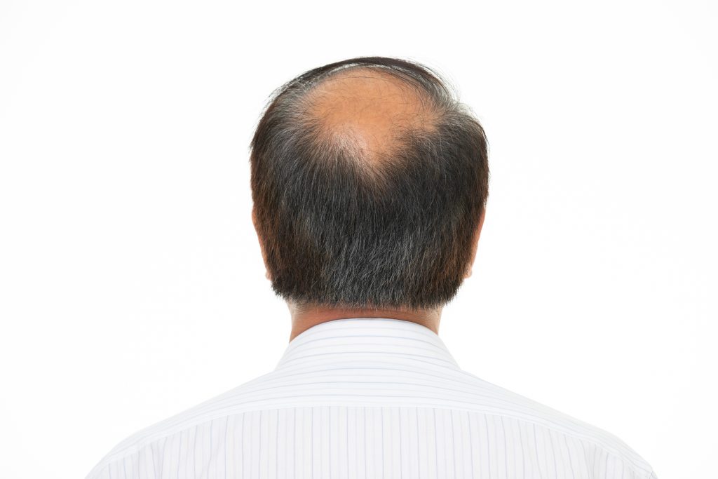 脱发比掉发多？有何药食同源防脱方